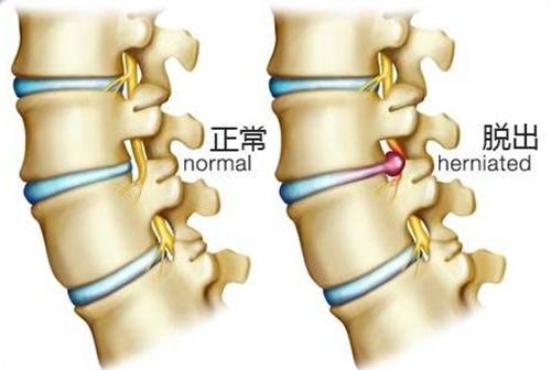 铁腰板真的有效果吗 骨病患者如何选择
